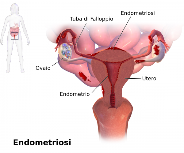 Blausen_0349_Endometriosis-it